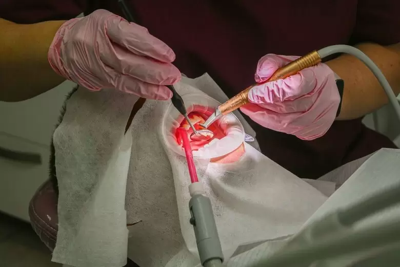 Профессиональная чистка зубов: важные рекомендации